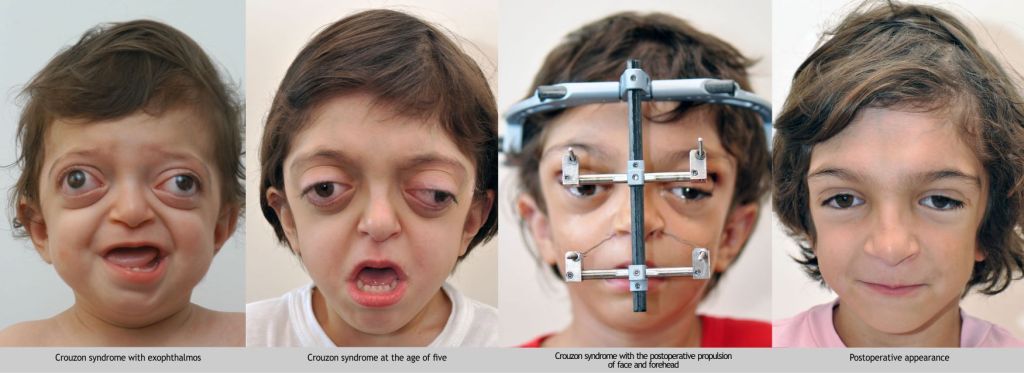 Outcome of a Craniofacial Surgery undergone by a child